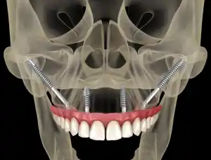 Zygomatic Dental Implants
