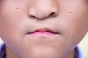 cleft and lip palate doctor texas
