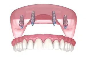 full mouth dental implants in houston