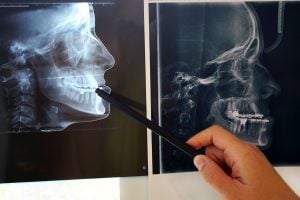 teeth for jaw bone health fort worth TX