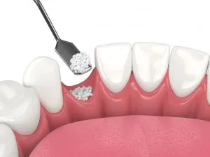 bone and gum grafting Fort Worth TX